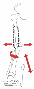 Misaligned Lower Leg